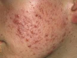 acne
